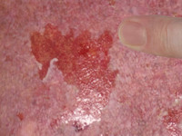 Nikolsky fenomeen 1 blaarvorming bij wrijven