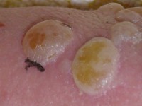 Nikolsky fenomeen 2, stevige blaar onder streepje door drukken