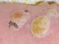 Nikolsky fenomeen 2, stevige blaar onder streepje door drukken