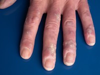 Nivolumab-induced lichen planus
