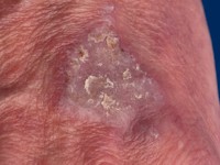Nivolumab-induced lichen planus