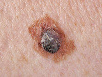 Nodulair melanoma