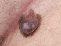 Nodulair melanoma