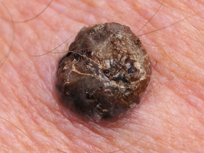 Nodular melanoma