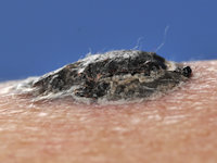 Nodulair melanoma