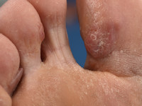 Nodular localized cutaneous amyloidosis