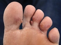 Nodular localized cutaneous amyloidosis