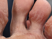 Nodular localized cutaneous amyloidosis