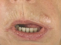 Nodular localized cutaneous amyloidosis