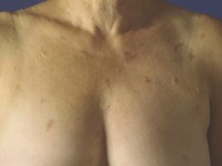 Nodular localized cutaneous amyloidosis