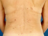 Nodular localized cutaneous amyloidosis