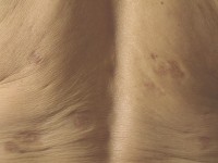 Nodular localized cutaneous amyloidosis