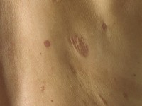 Nodular localized cutaneous amyloidosis