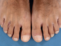 Nodular localized cutaneous amyloidosis