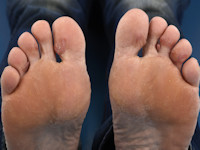 Nodular localized cutaneous amyloidosis