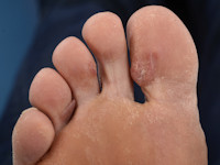 Nodular localized cutaneous amyloidosis