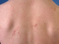 Nonbullous congenital ichthyosiform erythroderma