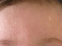 Nonbullous congenital ichthyosiform erythroderma