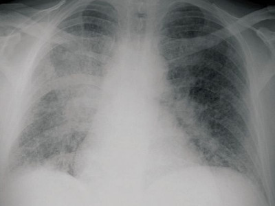 Blastomycosis Americana
