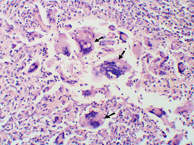 Blastomycosis Americana
