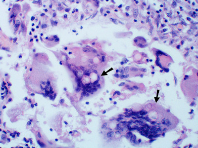 Blastomycosis Americana