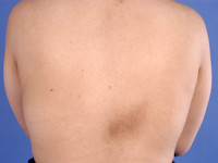 Notalgia paresthetica