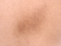 Notalgia paresthetica