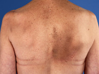 Notalgia paresthetica