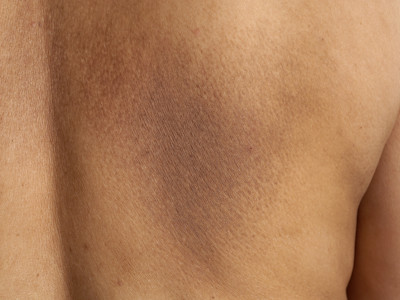 Notalgia paresthetica