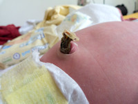 Omphalitis, navelstreng infectie