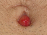 Omphalitis, navelstreng infectie