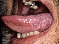 Oral hairy leukoplakia