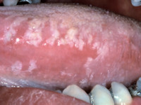 Oral hairy leukoplakia