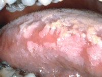 Oral hairy leukoplakia