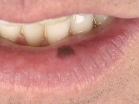 Orale melanosis (melanotic macule)