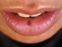 Orale melanosis (melanotic macule)