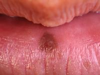 Orale melanosis (melanotic macule)