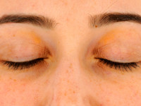 Orange palpebral spots