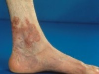 Woringer-Kollop disease, CTCL type pagetoide reticulosis