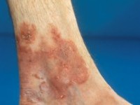 Woringer-Kollop disease, CTCL type pagetoide reticulosis