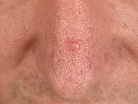 Palisaded encapsulated neuroma (PEN)