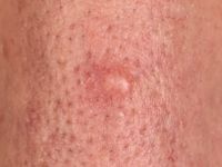 Palisaded encapsulated neuroma (PEN)