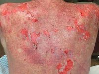Paraneoplastische pemphigus
