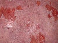 Paraneoplastische pemphigus