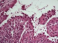 Paraneoplastische pemphigus