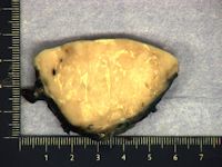 Paraneoplastische pemphigus