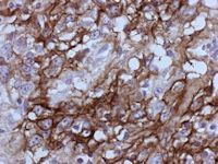 Paraneoplastische pemphigus