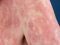 Large plaque parapsoriasis