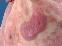 Large plaque parapsoriasis