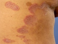 Large plaque parapsoriasis